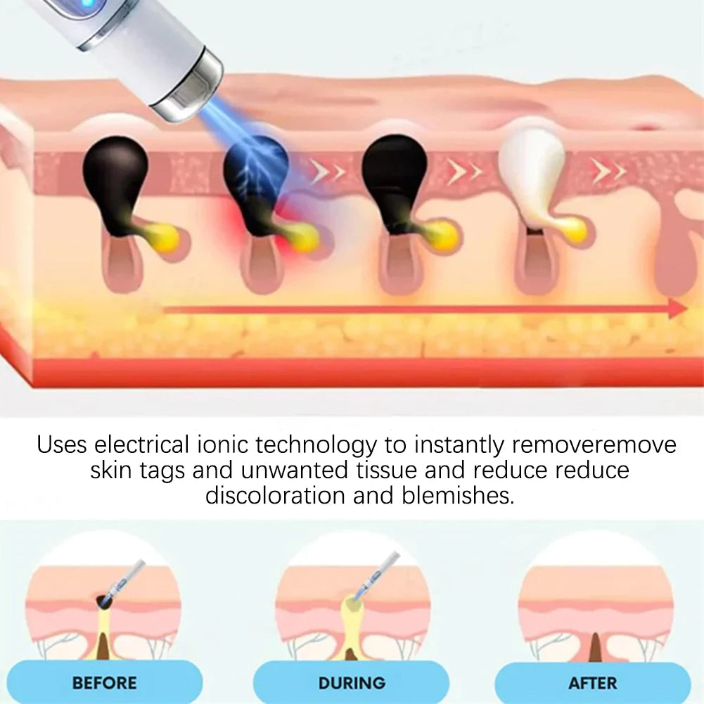 Warts Removal Laser Pen